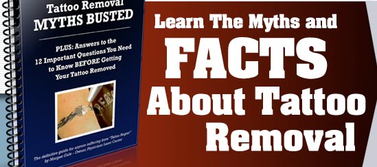 Tattoo Removal Facts