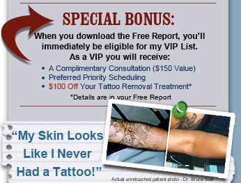 Tattoo Removal Before and After